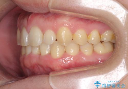 前歯のすき間 歯のがたつきの治療後