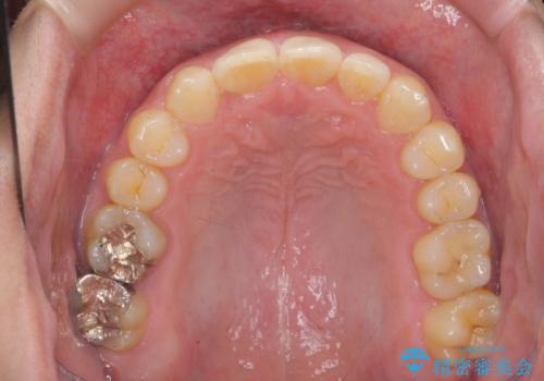 前歯のすき間 歯のがたつきの治療後