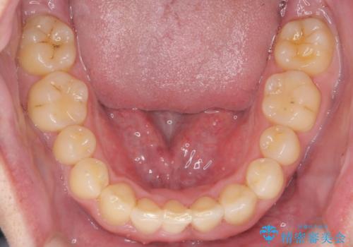 前歯のすき間 歯のがたつきの治療後