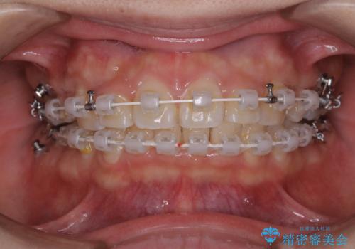 部分矯正で前歯をなおしたい→全顎ワイヤー矯正できちんと治すの治療中