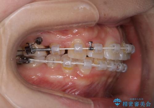 部分矯正で前歯をなおしたい→全顎ワイヤー矯正できちんと治すの治療中