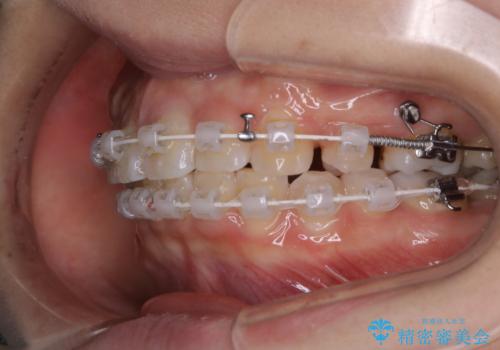 部分矯正で前歯をなおしたい→全顎ワイヤー矯正できちんと治すの治療中
