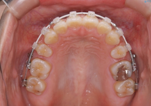 部分矯正で前歯をなおしたい→全顎ワイヤー矯正できちんと治すの治療中