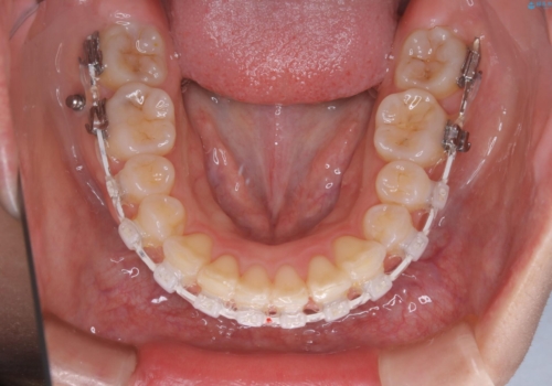 部分矯正で前歯をなおしたい→全顎ワイヤー矯正できちんと治すの治療中