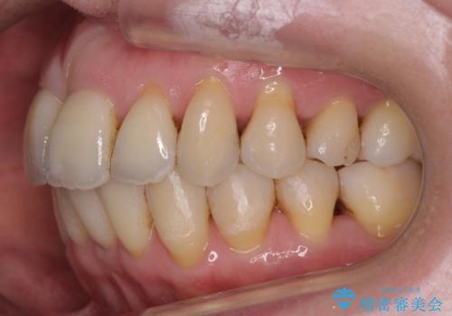 奥歯が倒れてしまっている 親知らずを利用した矯正の治療後