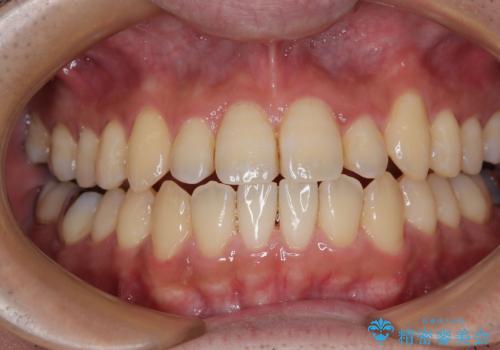 内側に引っ込んだ歯を治したい インビザラインの矯正治療の治療中