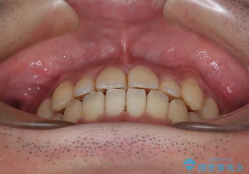 内側に引っ込んだ歯を治したい インビザラインの矯正治療の治療中