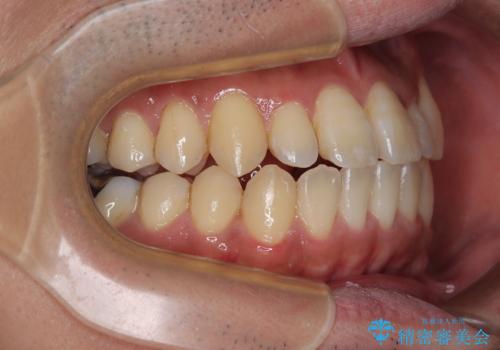 内側に引っ込んだ歯を治したい インビザラインの矯正治療の治療中