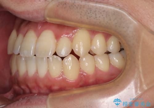 内側に引っ込んだ歯を治したい インビザラインの矯正治療の治療中