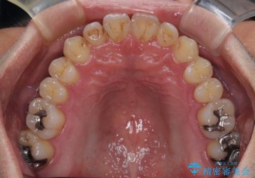 内側に引っ込んだ歯を治したい インビザラインの矯正治療の治療中