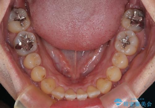 内側に引っ込んだ歯を治したい インビザラインの矯正治療の治療中