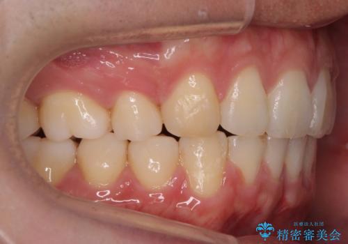 出っ歯の治療 インビザラインで抜歯矯正 親知らずを使用した矯正の治療後