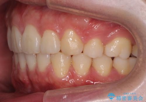 出っ歯の治療 インビザラインで抜歯矯正 親知らずを使用した矯正の治療後