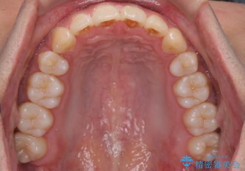 出っ歯の治療 インビザラインで抜歯矯正 親知らずを使用した矯正の治療後