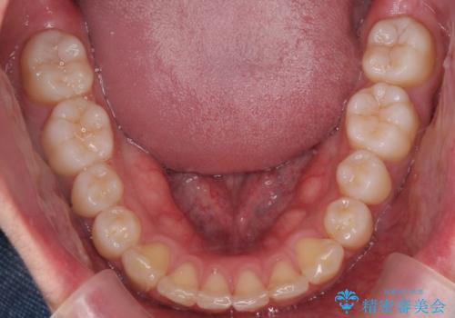 出っ歯の治療 インビザラインで抜歯矯正 親知らずを使用した矯正の治療後