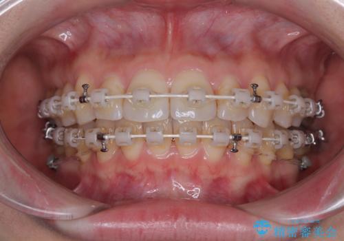 上下前歯のデコボコ ワイヤー装置で楽ちん矯正治療の治療中