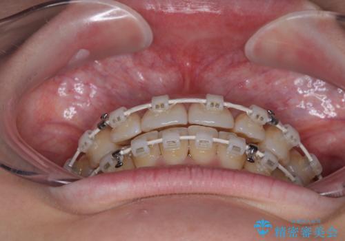 上下前歯のデコボコ ワイヤー装置で楽ちん矯正治療の治療中