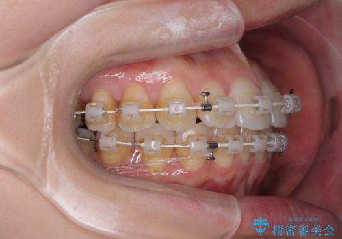 上下前歯のデコボコ ワイヤー装置で楽ちん矯正治療の治療中