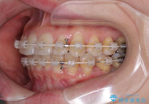 上下前歯のデコボコ ワイヤー装置で楽ちん矯正治療の治療中