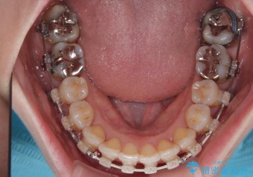 上下前歯のデコボコ ワイヤー装置で楽ちん矯正治療の治療中