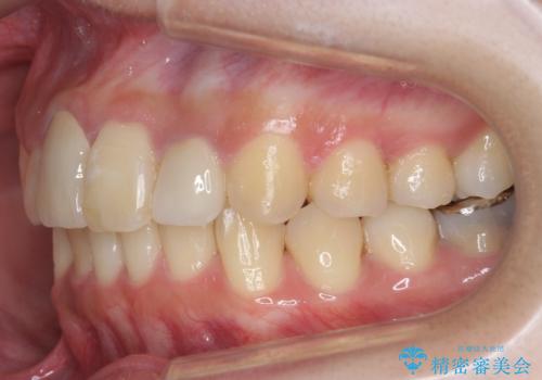 前歯のがたつき 保険治療の前歯の被せ物もやりかえたいの治療後