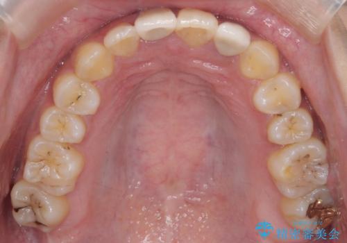 前歯のがたつき 保険治療の前歯の被せ物もやりかえたいの治療後