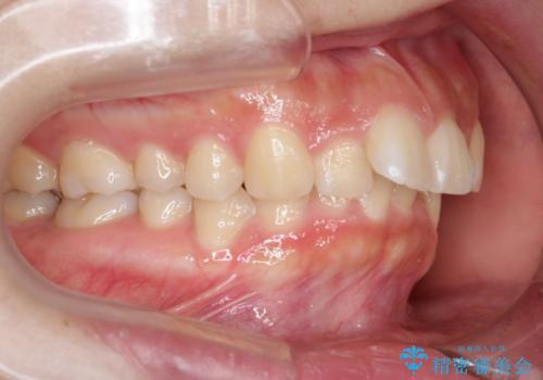 部分矯正で前歯をなおしたい→全顎ワイヤー矯正できちんと治すの治療前