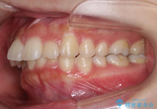 部分矯正で前歯をなおしたい→全顎ワイヤー矯正できちんと治すの治療前