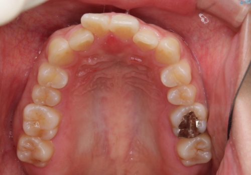 部分矯正で前歯をなおしたい→全顎ワイヤー矯正できちんと治すの治療前