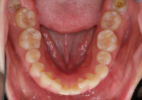 部分矯正で前歯をなおしたい→全顎ワイヤー矯正できちんと治すの治療前