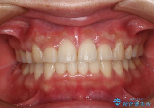 部分矯正で前歯をなおしたい→全顎ワイヤー矯正できちんと治すの治療後