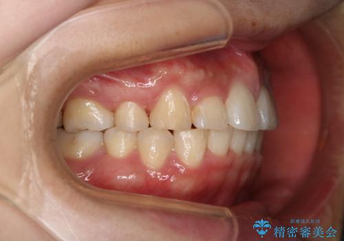 部分矯正で前歯をなおしたい→全顎ワイヤー矯正できちんと治すの治療後