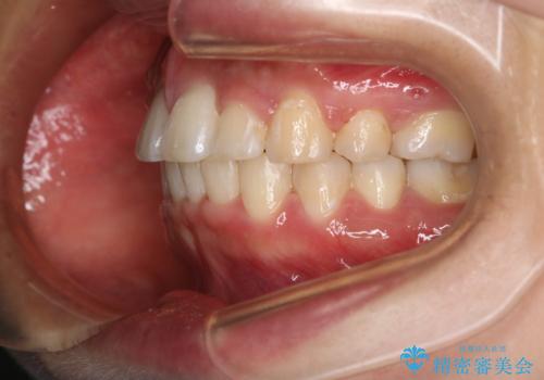 部分矯正で前歯をなおしたい→全顎ワイヤー矯正できちんと治すの治療後