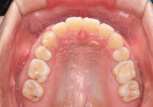 部分矯正で前歯をなおしたい→全顎ワイヤー矯正できちんと治すの治療後