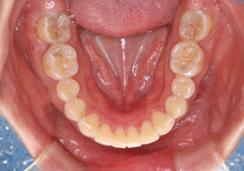 部分矯正で前歯をなおしたい→全顎ワイヤー矯正できちんと治すの治療後