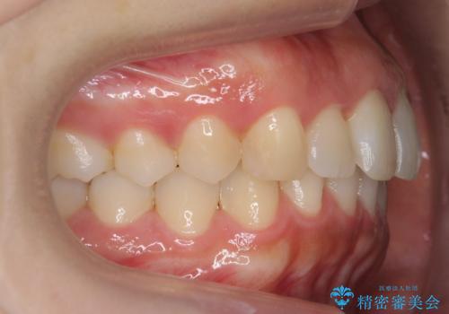 出っ歯の治療 抜かずに 短期間で目立たない治療の治療後