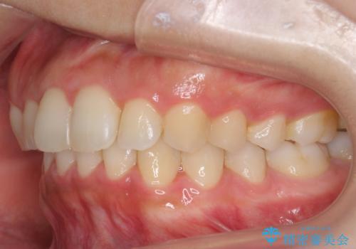 出っ歯の治療 抜かずに 短期間で目立たない治療の治療後