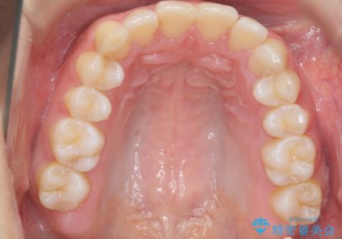 出っ歯の治療 抜かずに 短期間で目立たない治療の治療後