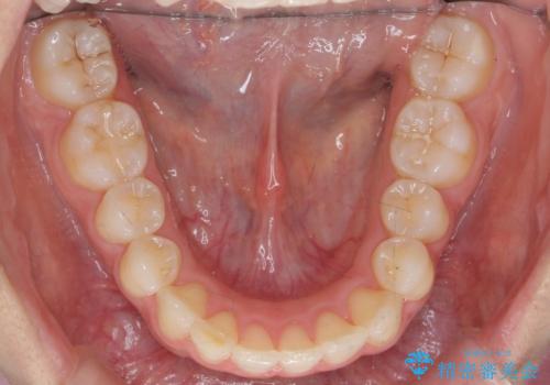 出っ歯の治療 抜かずに 短期間で目立たない治療の治療後