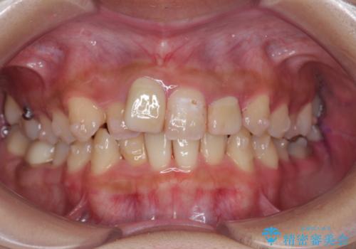 前歯のがたつき 保険治療の前歯の被せ物もやりかえたいの治療中