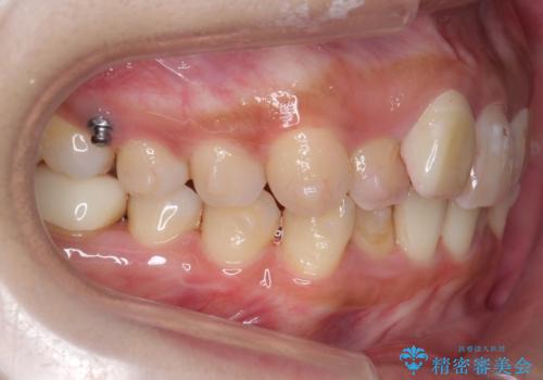 前歯のがたつき 保険治療の前歯の被せ物もやりかえたいの治療中