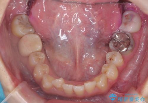 前歯のがたつき 保険治療の前歯の被せ物もやりかえたいの治療中