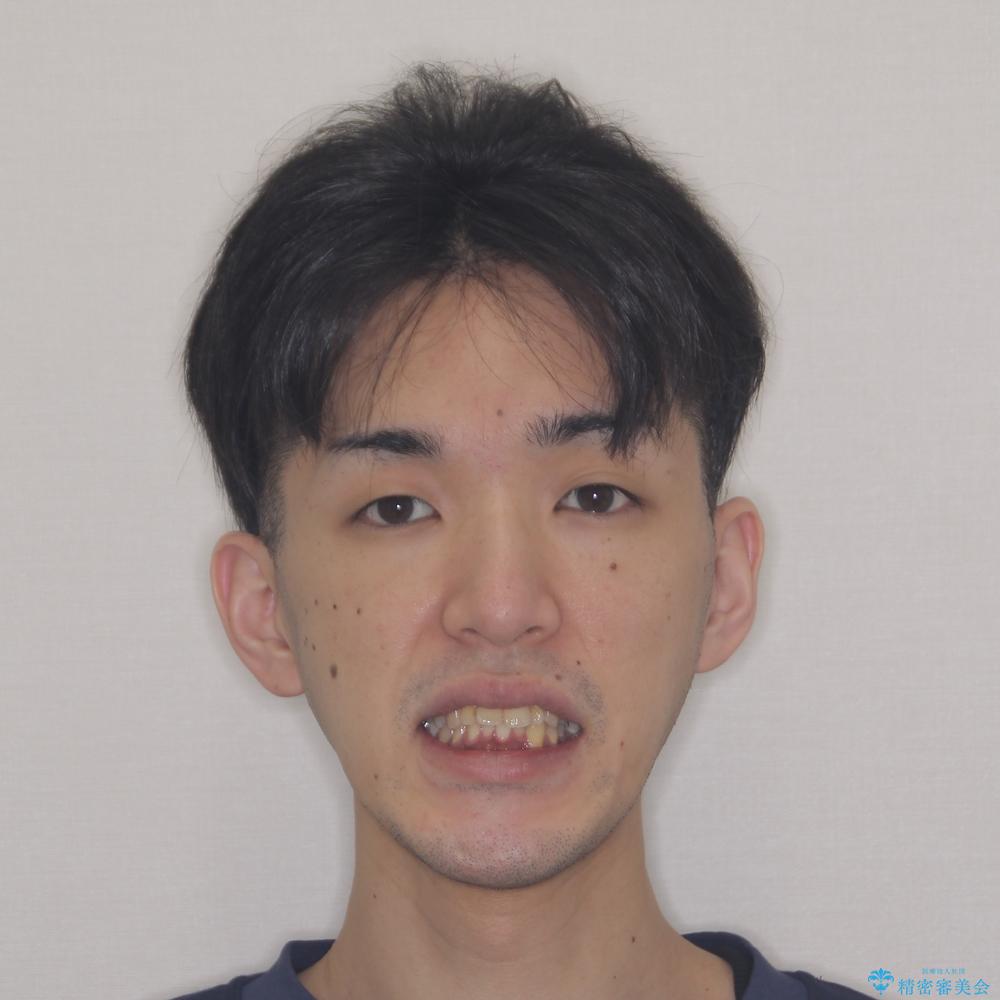 【モニター】飛び出した上の前歯 非抜歯矯正で整った口元にの治療前(顔貌)