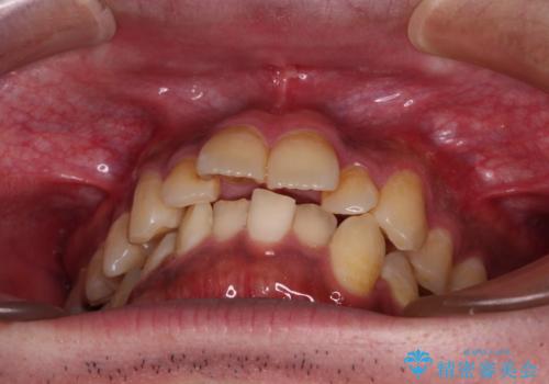 【モニター】飛び出した上の前歯 非抜歯矯正で整った口元にの治療前