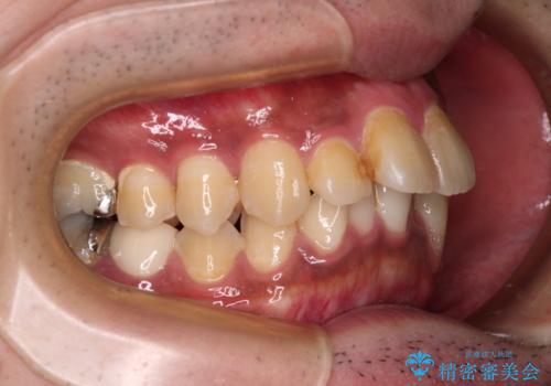 【モニター】飛び出した上の前歯 非抜歯矯正で整った口元にの治療前