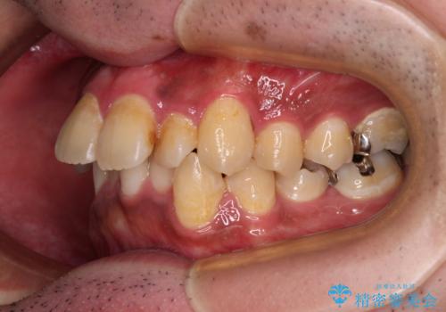 【モニター】飛び出した上の前歯 非抜歯矯正で整った口元にの治療前