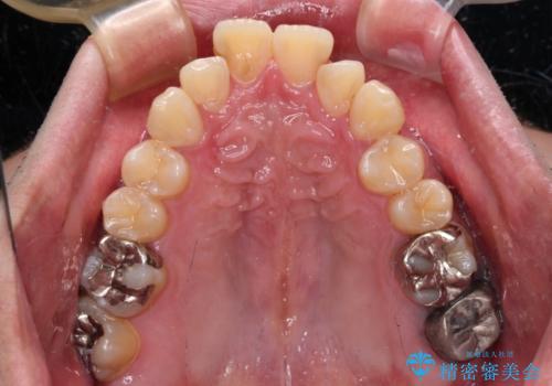 【モニター】飛び出した上の前歯 非抜歯矯正で整った口元にの治療前