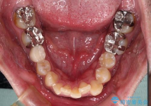 【モニター】飛び出した上の前歯 非抜歯矯正で整った口元にの治療前