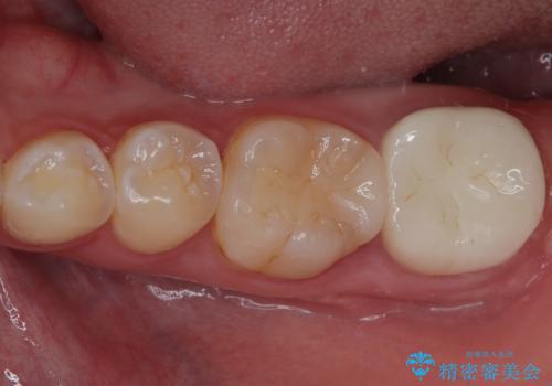 噛むと痛い 奥歯のむし歯治療の症例 治療後