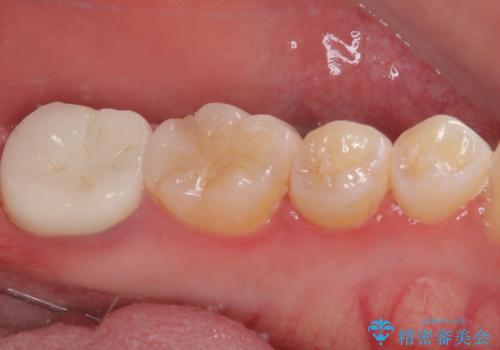 噛むと痛い 奥歯のむし歯治療の治療後